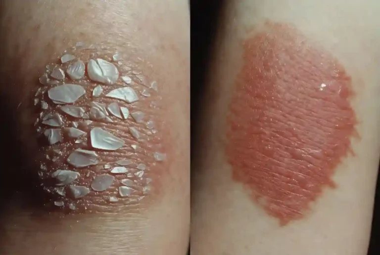 Psoriasis vs Eczema
